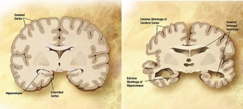 Alzheimer's_disease_brain_comparison